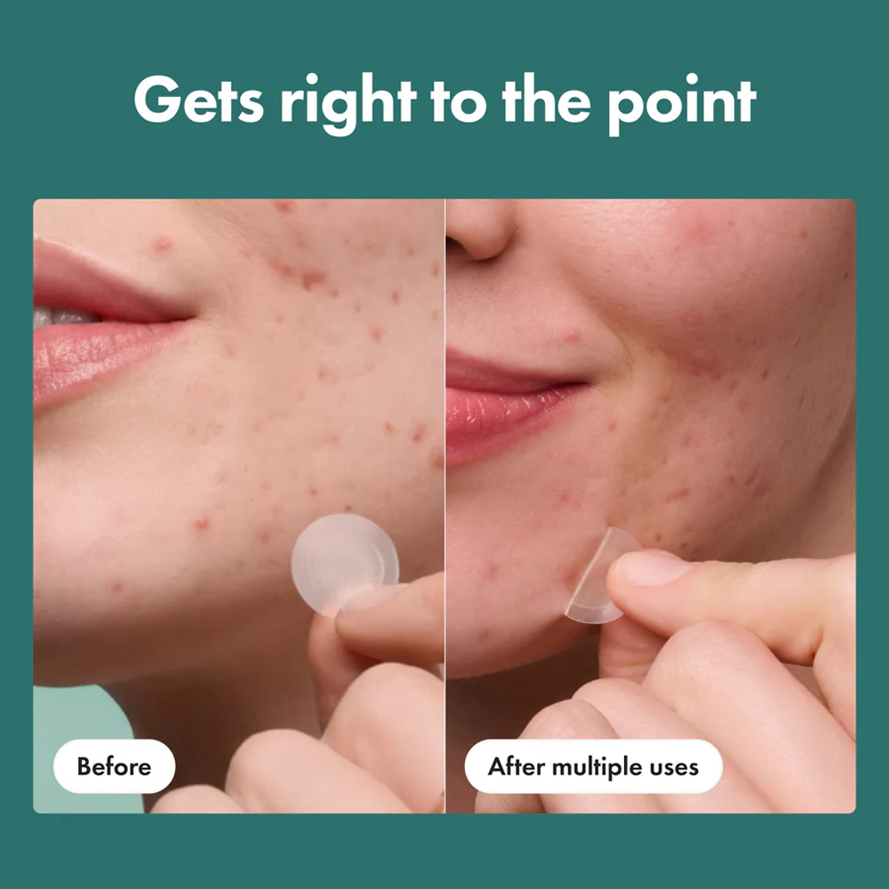 Micropoint for Blemishes - Image 4